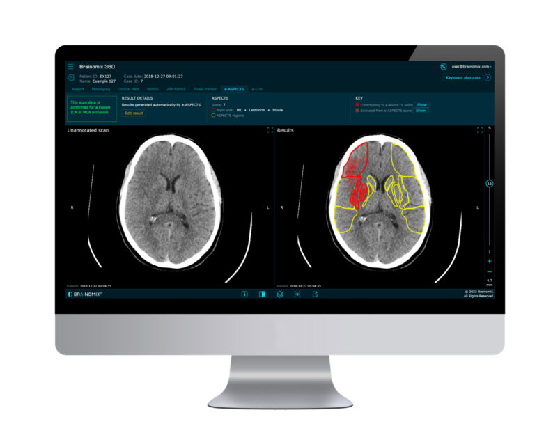 Brainomix збирає 14 мільйонів фунтів стерлінгів для розчину візуалізації, що працює на AI, для інсульту, фіброзу легенів